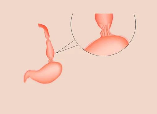 Achalasia Cardia consultation at Niraaya Hospital